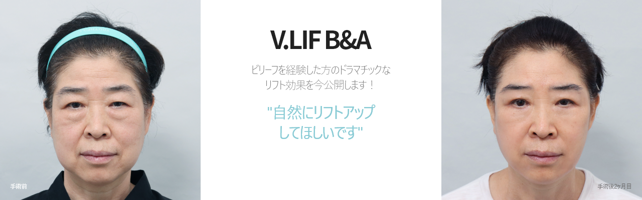 V.LIF B&A  ビリーフを経験した方のドラマチックな リフト効果を今公開します！ '自然にリフトアップ してほしいです'