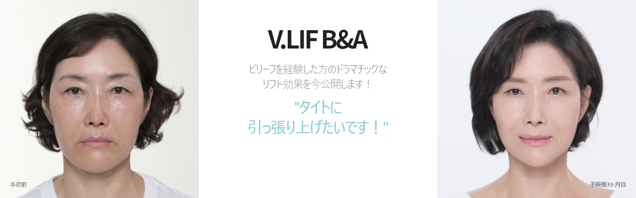 V.LIF B&A  ビリーフを経験した方のドラマチックな リフト効果を今公開します！ 'タイトに 引っ張り上げたいです！'