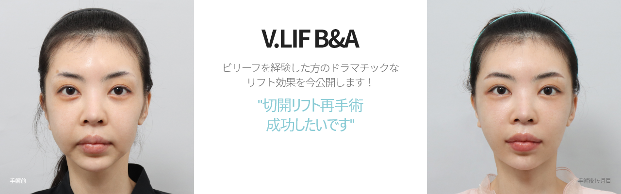 V.LIF B&A  ビリーフを経験した方のドラマチックな リフト効果を今公開します！ '切開リフト再手術 成功したいです'