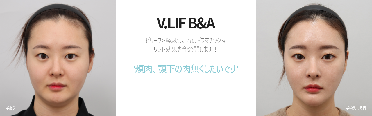 V.LIF B&A  ビリーフを経験した方のドラマチックな リフト効果を今公開します！ '頬肉、顎下の肉無くしたいです'