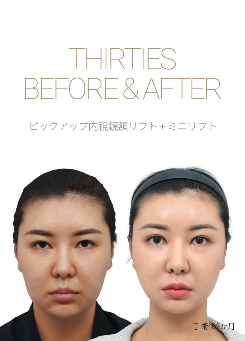 BEFORE & AFTER 픽업 내시경이마거상 + 미니거상