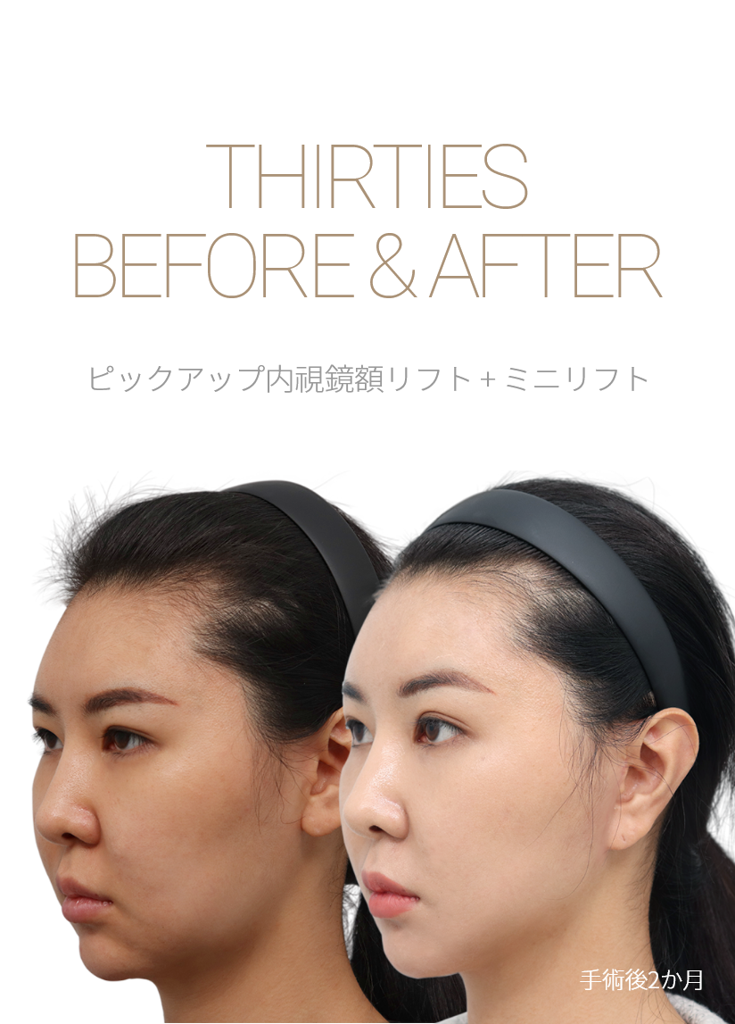 BEFORE & AFTER 픽업 내시경이마거상 + 미니거상