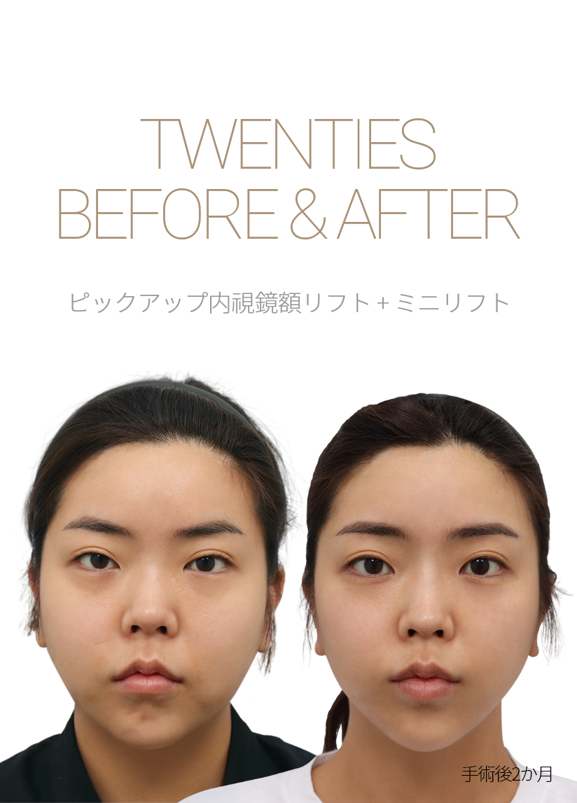 BEFORE & AFTER 픽업 내시경이마거상 + 미니거상