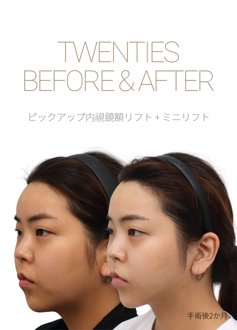 BEFORE & AFTER 픽업 내시경이마거상 + 미니거상