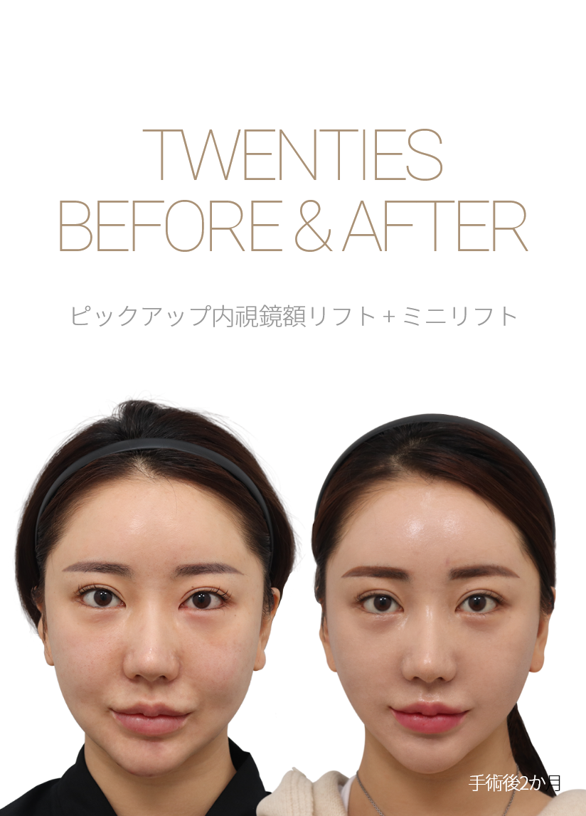 BEFORE & AFTER 픽업 내시경이마거상 + 미니거상