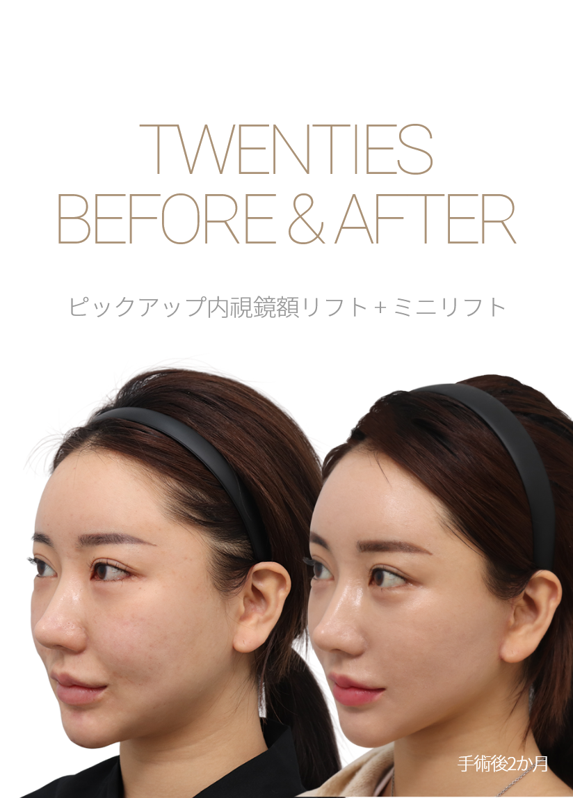 BEFORE & AFTER 픽업 내시경이마거상 + 미니거상