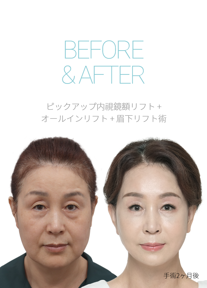 BEFORE & AFTER 픽업 내시경이마거상 + 올인거상 + 눈썹하거상