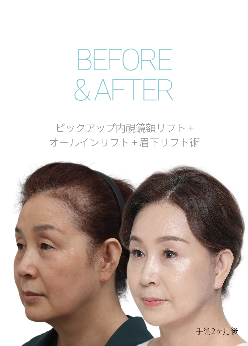 BEFORE & AFTER 픽업 내시경이마거상 + 올인거상 + 눈썹하거상