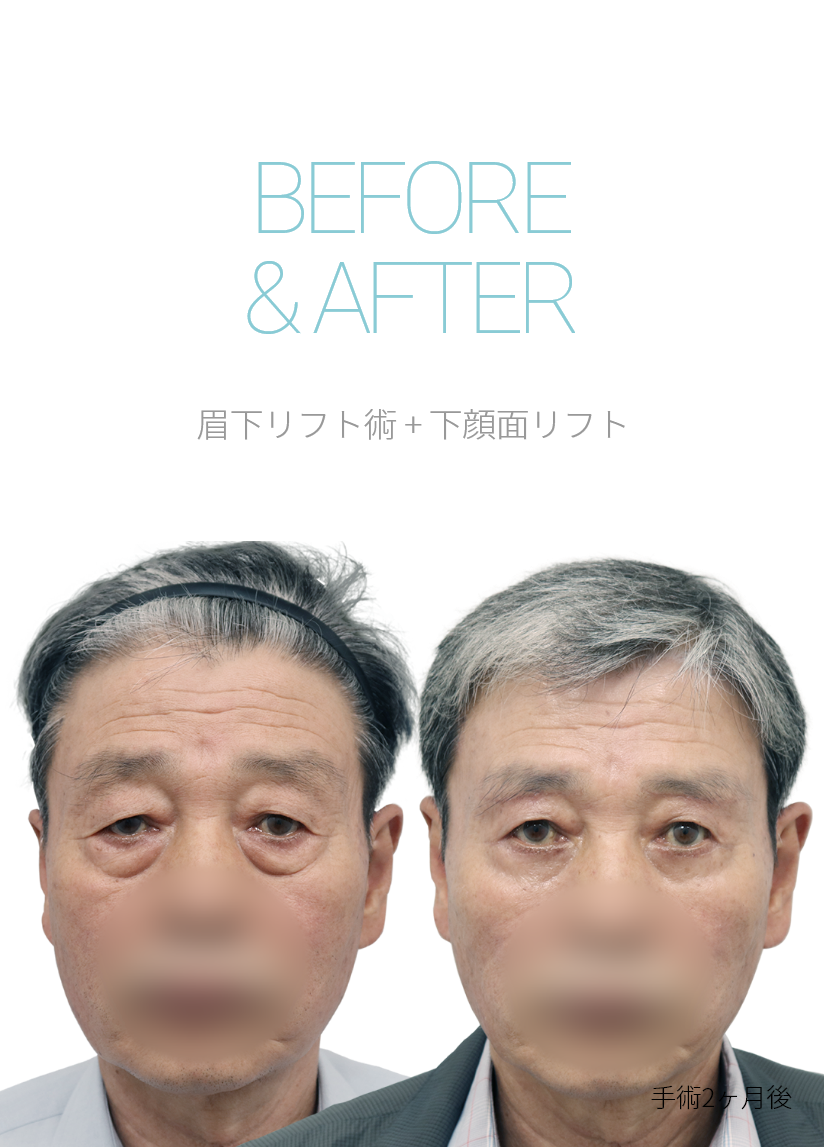 BEFORE & AFTER 눈썹하거상 + 하안검