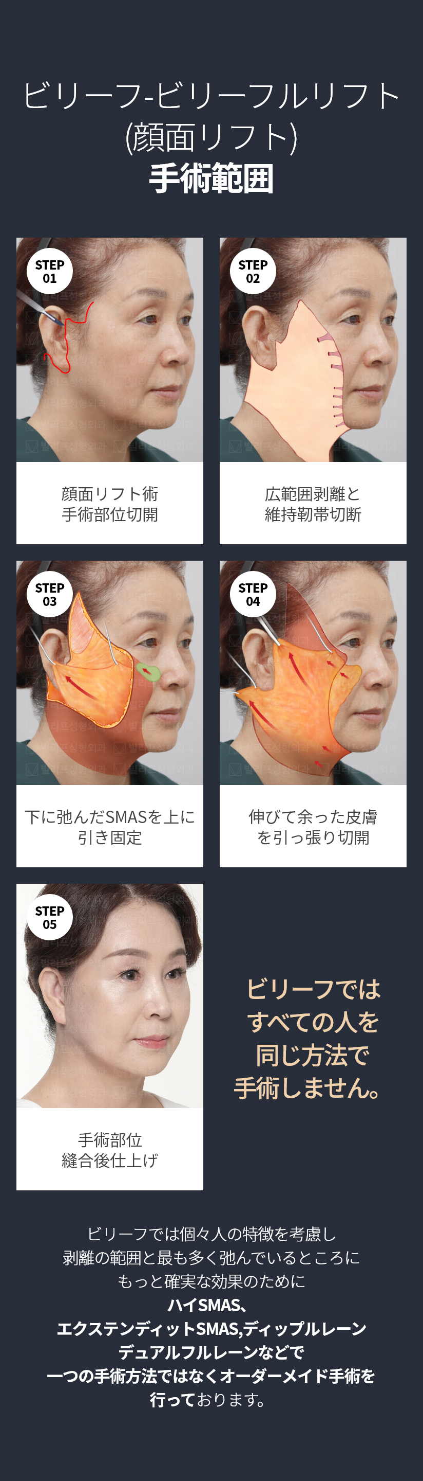 빌리프 - 빌리풀거상(안면거상술) 수술방법 STEP01 - 안면거상술 수술부위 절개, STEP02 - 광범위 박리와 유지인대 끊기, STEP03 - 아래로 처진 스마스를 위로 당겨 고정, STEP04 - 늘어지고 남은 피부를 당겨 절제, STEP05 - 수술부위 봉합 후 마무리 * 빌리프에서는 모든 사람을 똑같은 방식으로 수술하지 않습니다. * 빌리프에서는 개개인의 특성을 고려하여 박리의 범위와 가장 많이 처져있는 곳에 더 확실한 효과를 위하여 하이스마스, 익스텐디드스마스, 딥플레인, 듀얼플레인 등으로 한가지 수술법이 아닌 맞춤형 수술을 진행하고있습니다.