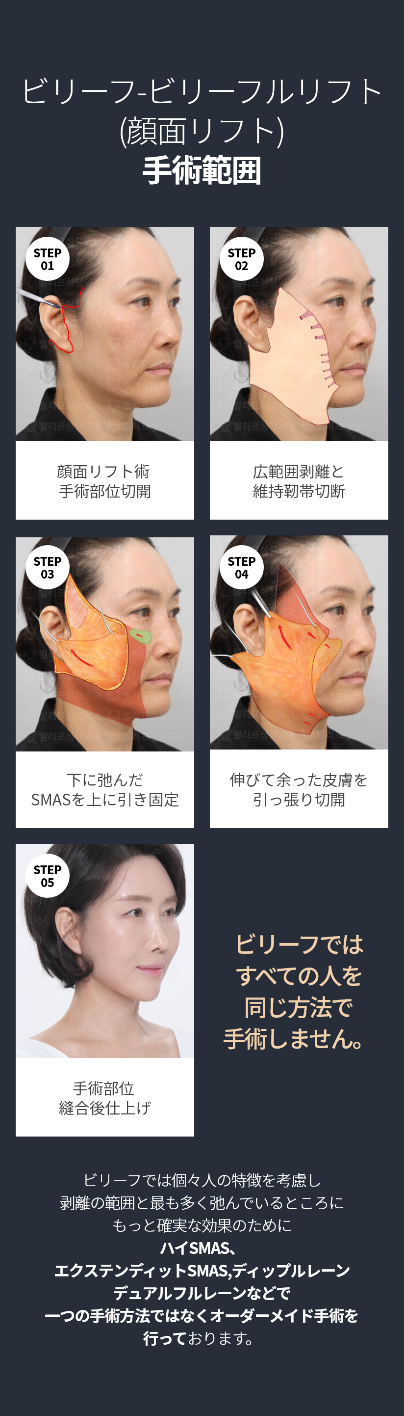 빌리프 - 빌리풀거상(안면거상술) 수술방법 STEP01 - 안면거상술 수술부위 절개, STEP02 - 광범위 박리와 유지인대 끊기, STEP03 - 아래로 처진 스마스를 위로 당겨 고정, STEP04 - 늘어지고 남은 피부를 당겨 절제, STEP05 - 수술부위 봉합 후 마무리 * 빌리프에서는 모든 사람을 똑같은 방식으로 수술하지 않습니다. * 빌리프에서는 개개인의 특성을 고려하여 박리의 범위와 가장 많이 처져있는 곳에 더 확실한 효과를 위하여 하이스마스, 익스텐디드스마스, 딥플레인, 듀얼플레인 등으로 한가지 수술법이 아닌 맞춤형 수술을 진행하고있습니다.