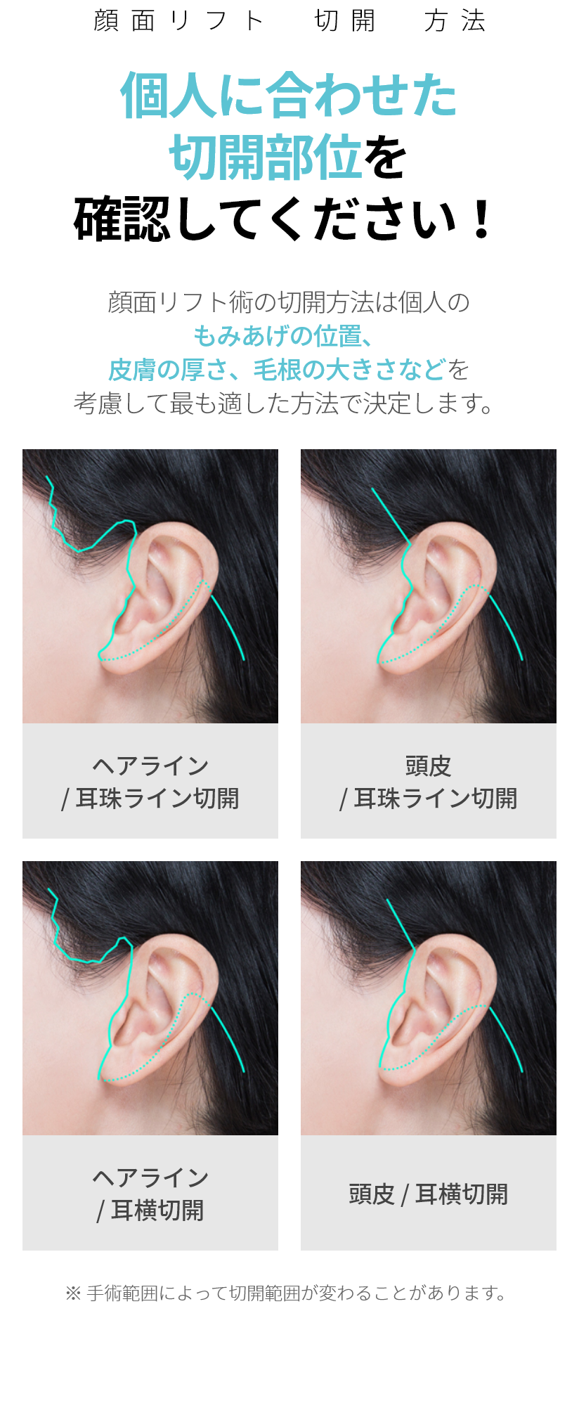 스마스미니거상술 개인맞춤 절개부위를 확인하세요! 스마스 미니거상술의 절개방법은 개인의 구렛나루의 위치,  피부 두께, 모공 크기 등을 고려하여 가장 적합한 방법으로 결정됩니다. *헤어라인/이주라인절개 *두피/이주라인 절개 *헤어라인/귀앞절개 *두피/귀앞 절개 ※ 수술 범위에 따라 절개범위가 달라질 수 있습니다.