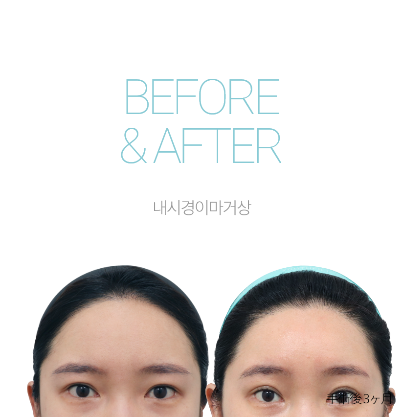 BEFORE & AFTER 픽업 내시경이마거상 + 올인거상 + 눈썹하거상