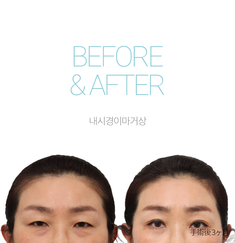 BEFORE & AFTER 미니거상재수술