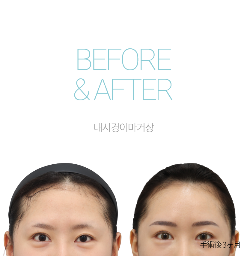 BEFORE & AFTER 눈썹하거상 + 하안검