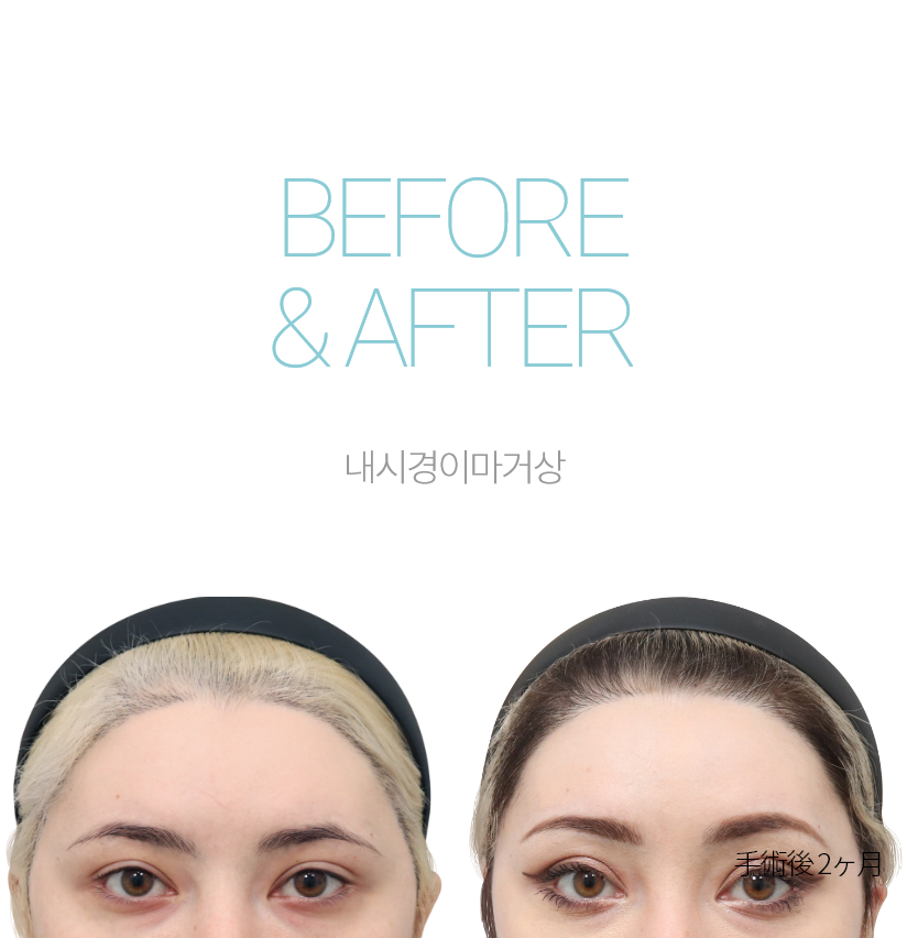 BEFORE & AFTER 눈썹하거상 + 하안검