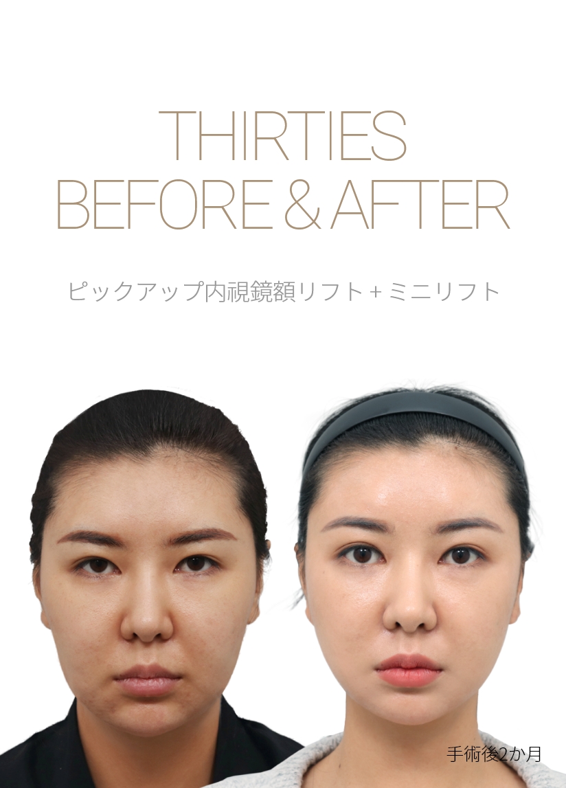 THIRTIES BEFORE & AFTER 픽업 내시경이마거상술 + 스마스리프팅