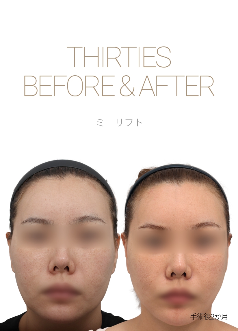 THIRTIES BEFORE & AFTER 미니거상