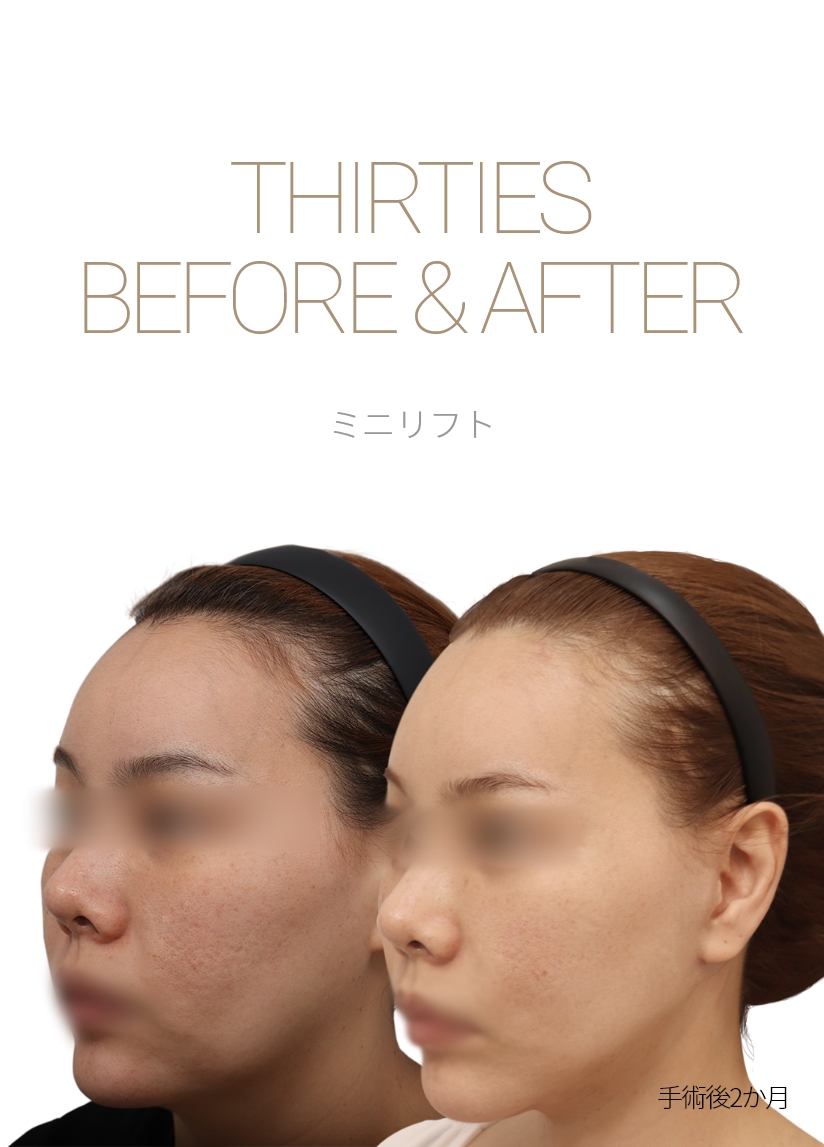 THIRTIES BEFORE & AFTER 미니거상