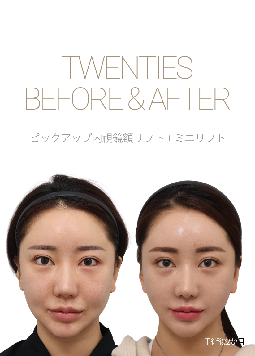 THIRTIES BEFORE & AFTER 픽업내시경이마거상 + 미니거상