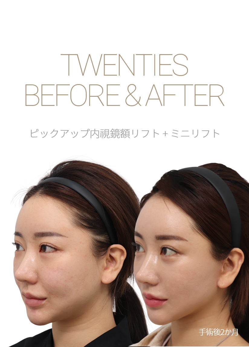 THIRTIES BEFORE & AFTER 픽업내시경이마거상 + 미니거상