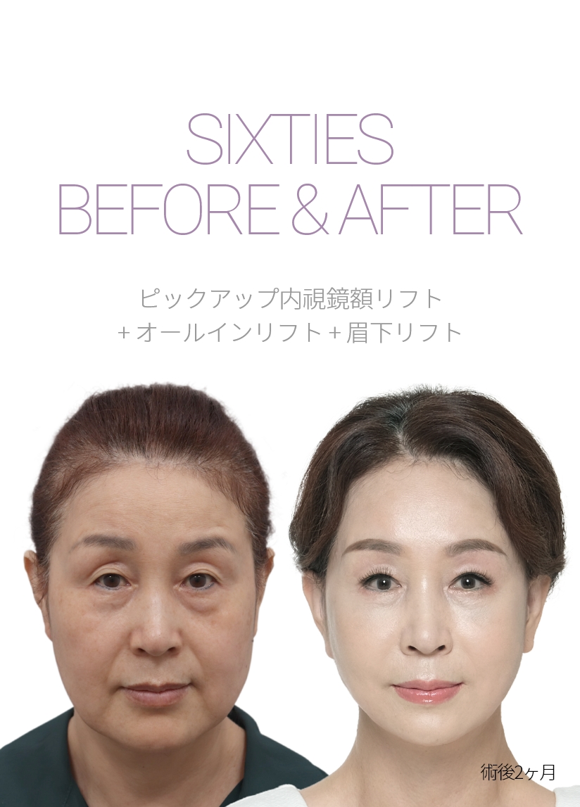 sixties BEFORE & AFTER 픽업내시경이마거상 + 올인거상 + 눈썹하거상 