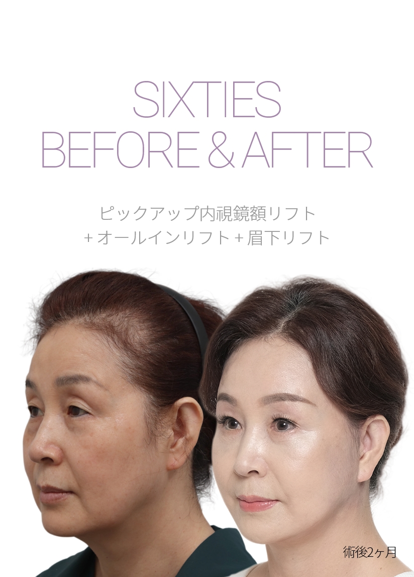 sixties BEFORE & AFTER 픽업내시경이마거상 + 올인거상 + 눈썹하거상 