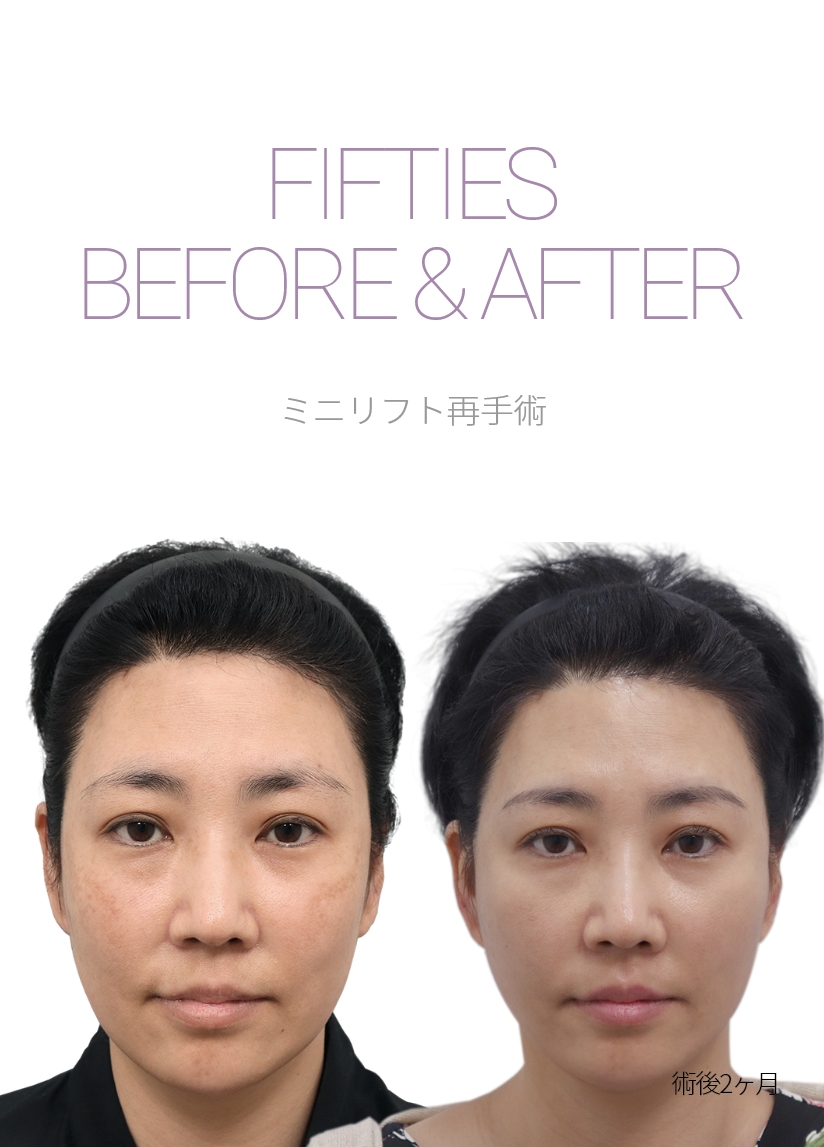 sixties BEFORE & AFTER 미니거상재수술