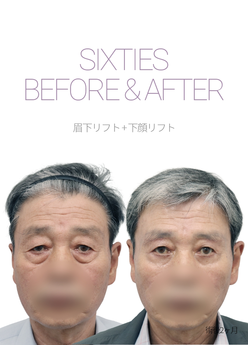 sixties BEFORE & AFTER 눈썹하거상 + 하안검