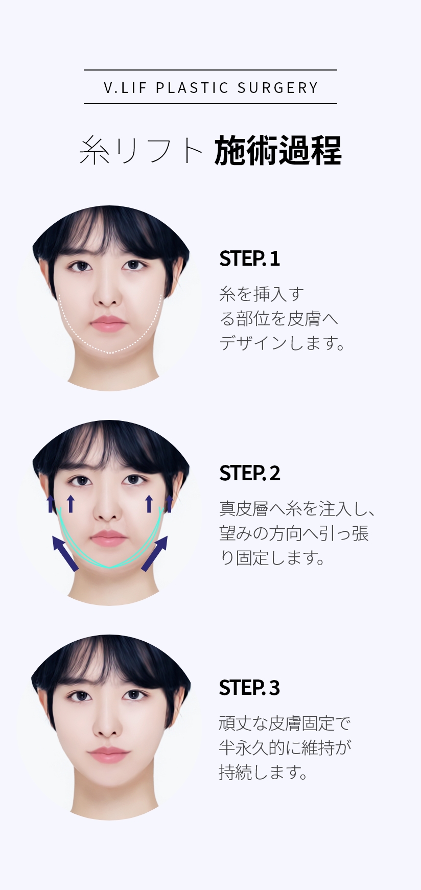 V.LIF PLASTIC SURGERY 실리프팅 시술과정 STEP. 1 - 실이 삽입될 부위를 피부에 디자인 합니다. STEP. 2 - 진피층에 실을 주입하여 원하는 방향으로 당겨 고정합니다. STEP. 3 - 견고한 피부고정으로 반영구적인 유지가 지속됩니다.