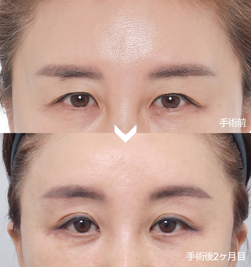 手術前 - 手術後2ヶ月目