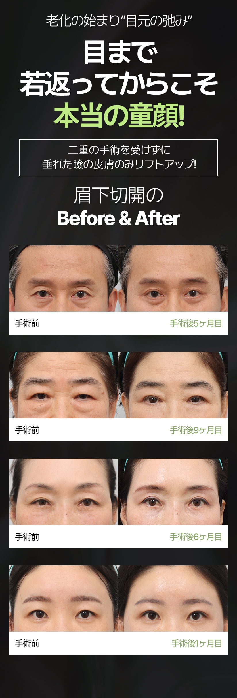 老化の始まり 目元の弛み  目まで若返ってからこそ 本当の童顔! 二重の手術を受けずに垂れた瞼の皮膚のみリフトアップ! 眉下切開の Before & After