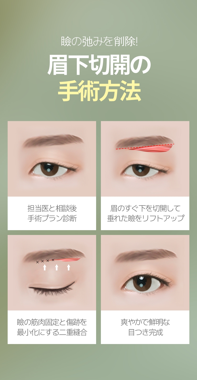 瞼の弛みを削除! 眉下切開の手術方法 担当医と相談後 手術プラン診断 眉のすぐ下を切開して 垂れた瞼をリフトアップ 瞼の筋肉固定と傷跡 を最小化にする二重縫合 爽やかで鮮明な 目つき完成