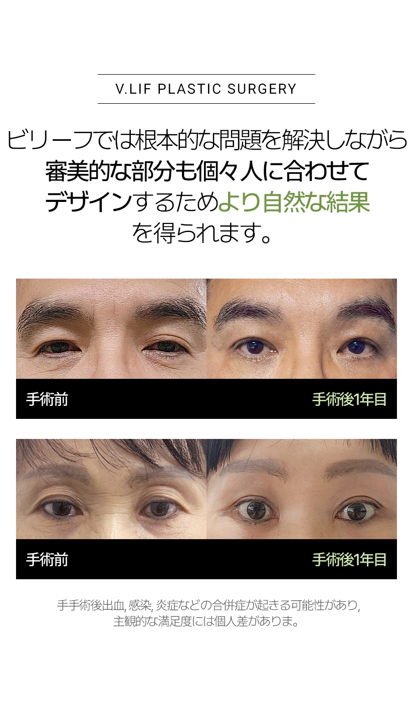 V.LIF PLASTIC SURGERY ビリーフでは根本的な問題を解決しながら 審美的な部分も個々人に合わせてデザインするため より自然な結果を得られます。手手術後出血, 感染, 炎症などの合併症が起きる可能性があり, 主観的な満足度には個人差がありま。