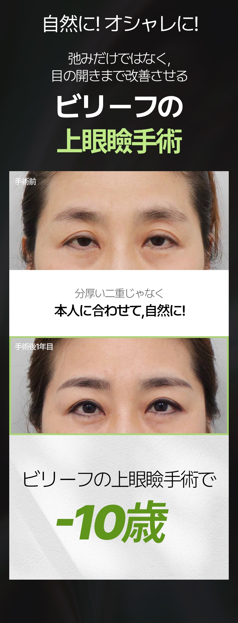 自然に! オシャレに! 弛みだけではなく、目の開きまで改善させる ビリーフの上眼瞼手術 手術前 分厚い二重じゃなく 本人に合わせて, 自然に! 手術後1年目 ビリーフの上眼瞼手術で -10歳