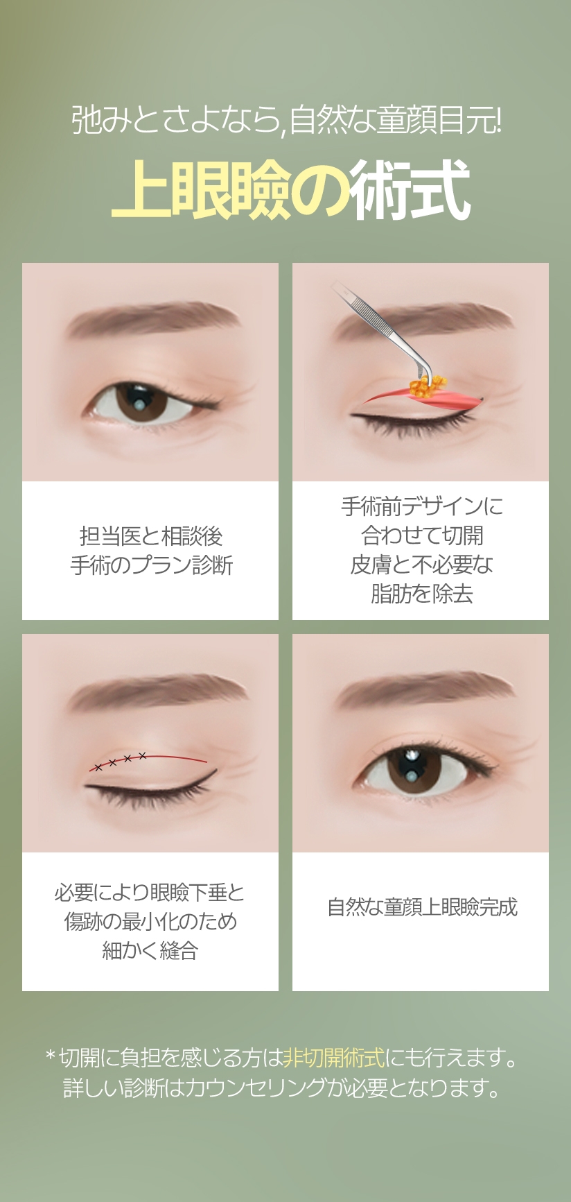 弛みとさよなら, 自然な童顔目元! 上眼瞼の術式 担当医と相談後 手術のプラン診断 手術前デザインに合わせて 切開皮膚と不必要な 脂肪を除去 必要により眼瞼下垂と 傷跡の最小化のため 細かく縫合 自然な童顔上眼瞼完成 * 切開に負担を感じる方は 非切開術式にも行えます。詳しい診断はカウンセリングが必要となります。