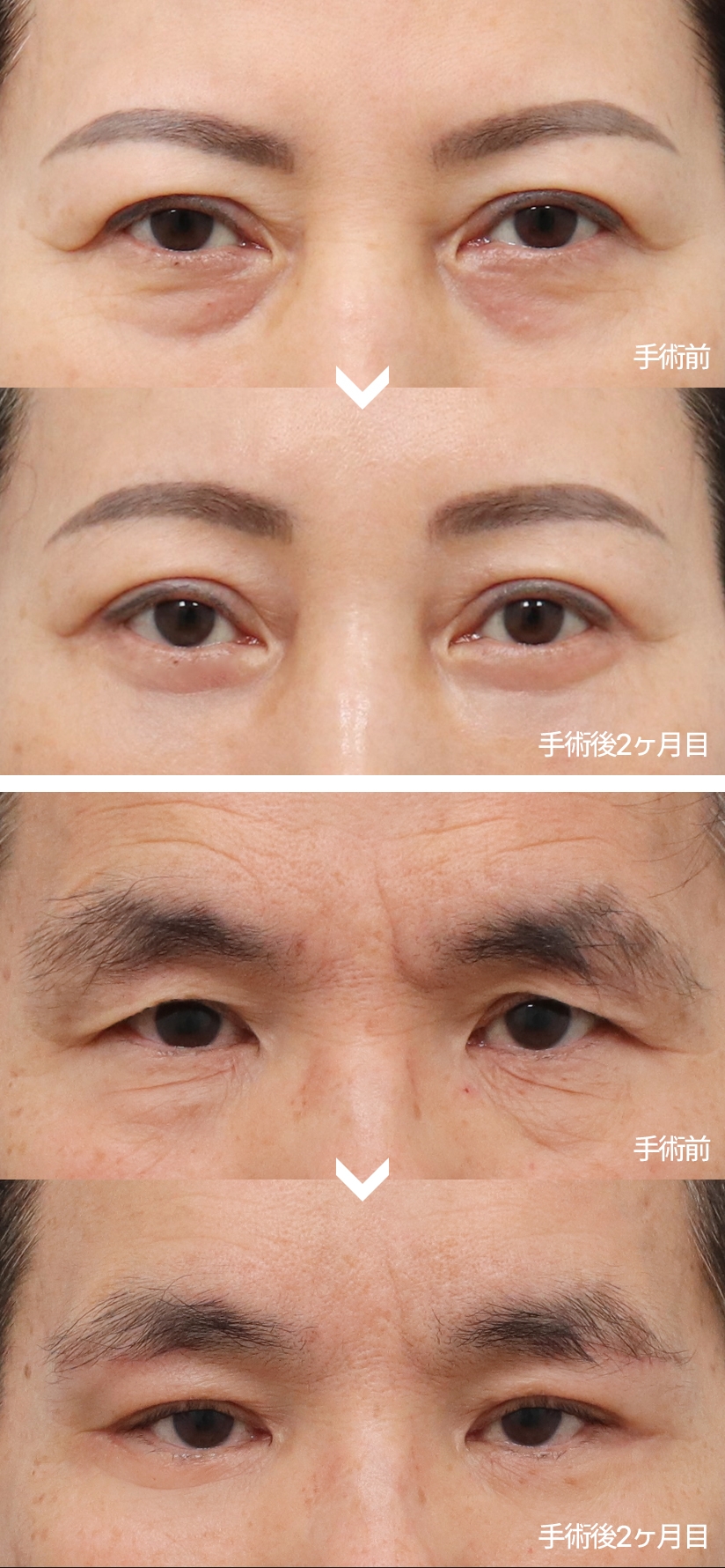 手術前 - 手術後2ヶ月目