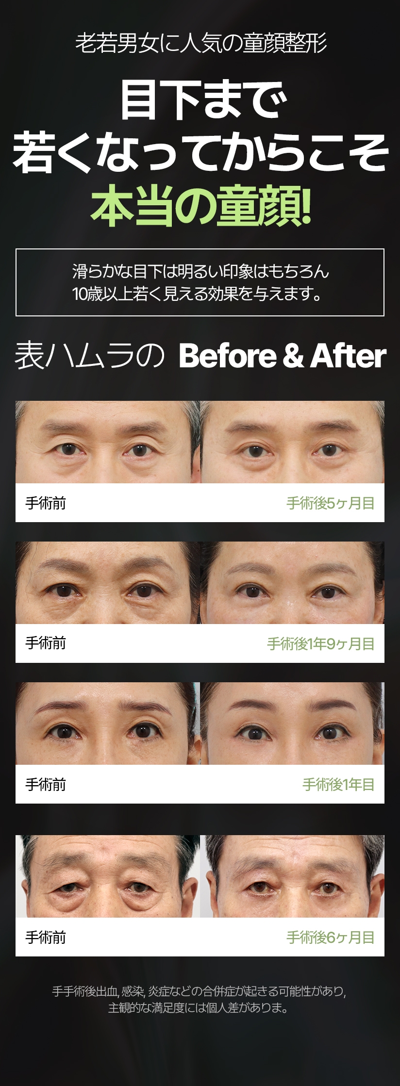 老若男女に人気の童顔整形 目下まで若くなってからこそ 本当の童顔! 滑らかな目下は明るい印象はもちろん, 10歳以上若く見える効果を与えます。表ハムラの  Before & After 手手術後出血, 感染, 炎症などの合併症が起きる可能性があり, 主観的な満足度には個人差がありま。