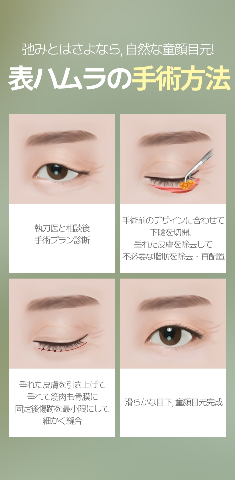 弛みとはさよなら, 自然な童顔目元! 表ハムラの 手術方法 執刀医と相談後 手術プラン診断 手術前のデザインに合わせて 下瞼を切開、 垂れた皮膚を除去して 不必要な脂肪を除去·再配置 垂れた皮膚を引き上げて 垂れて筋肉も骨膜に 固定後傷跡を最小限にして 細かく縫合 滑らかな目下, 童顔目元完成