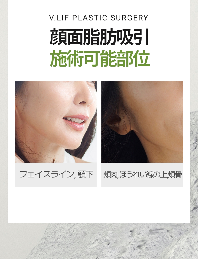V.LIF PLASTIC SURGERY ビリーフのボリューム脂肪移植 施術可能部位 額, 瞼, 前頬,ほうれい線, 顎先 * 移植する脂肪の採取は太もも, お腹など脂肪が多い部位から採取します。