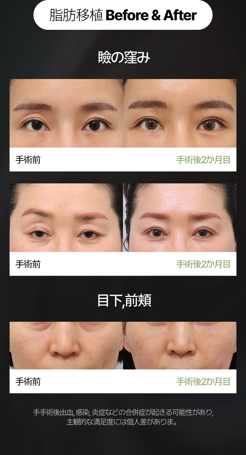 脂肪移植 Before & After 瞼の窪み 手手術後出血, 感染, 炎症などの合併症が起きる可能性があり, 主観的な満足度には個人差がありま。