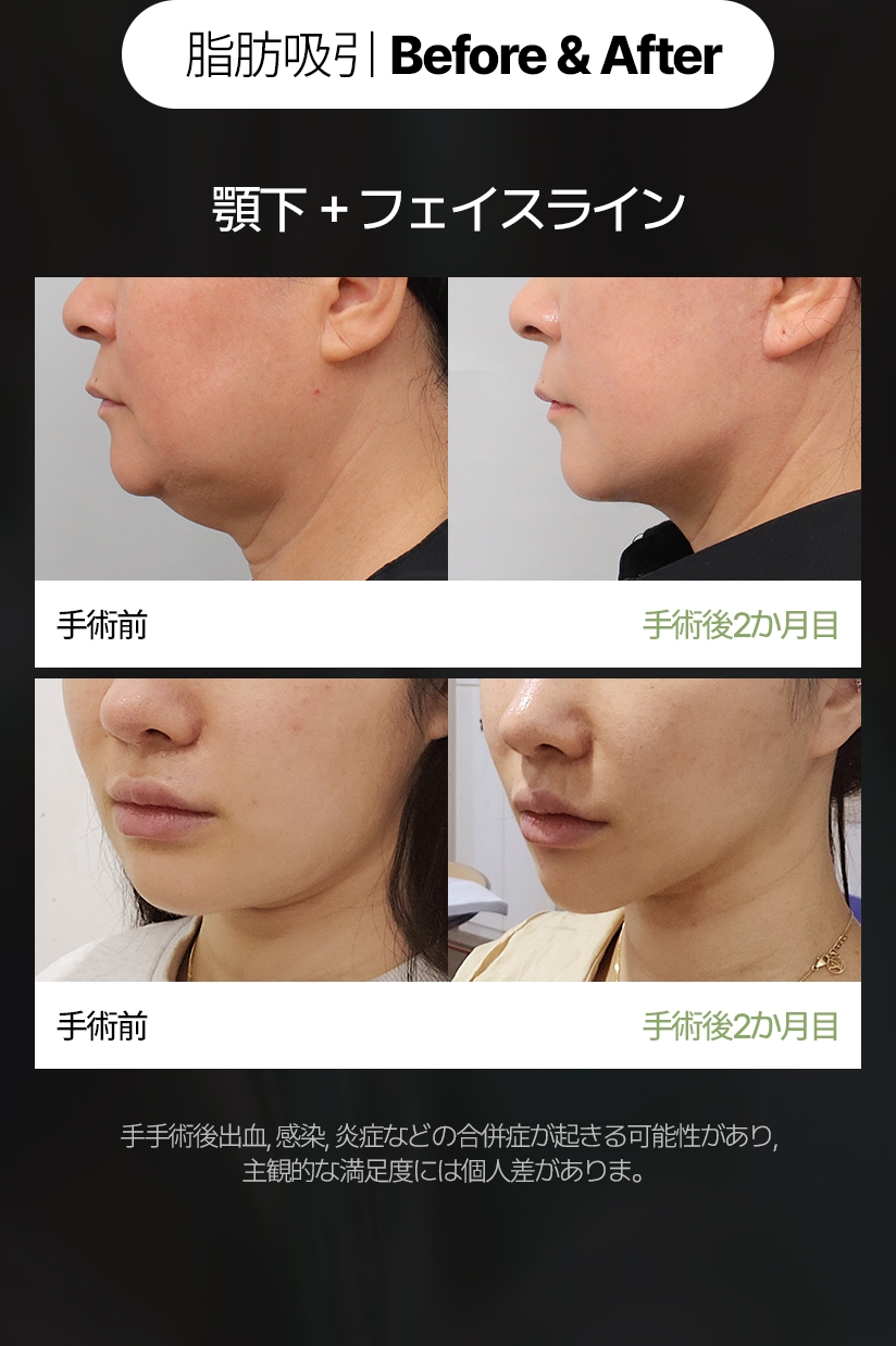 脂肪移植 Before & After 顎下＋フェイスライン 手手術後出血, 感染, 炎症などの合併症が起きる可能性があり, 主観的な満足度には個人差がありま。