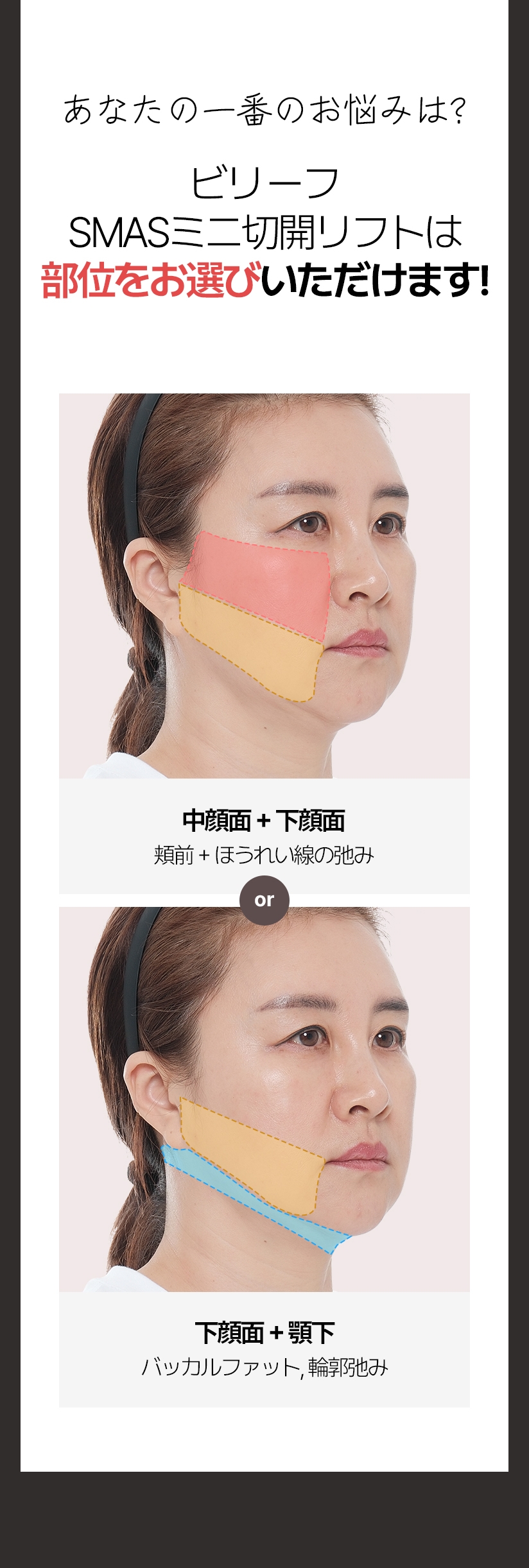 あなたの一番のお悩みは? ビリーフSMASミニ切開リフトは 部位をお選びいただけます! 中面部 + 下面部 頬前 + ほうれい線の弛み / 下顔面 + 顎下 バッカルファット、輪郭弛み