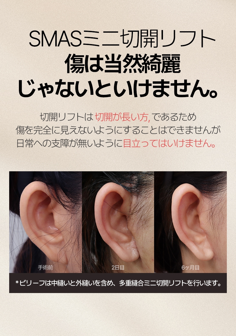 SMASミニ切開リフト 傷は当然綺麗じゃないといけません。切開リフトは 切開が長い方であるため 傷を完全に見えないようにすることはできませんが 日常への支障が無いように目立ってはいけません。* ビリーフは中縫いと外縫いを含め、多重縫合ミニ切開リフトを行います。