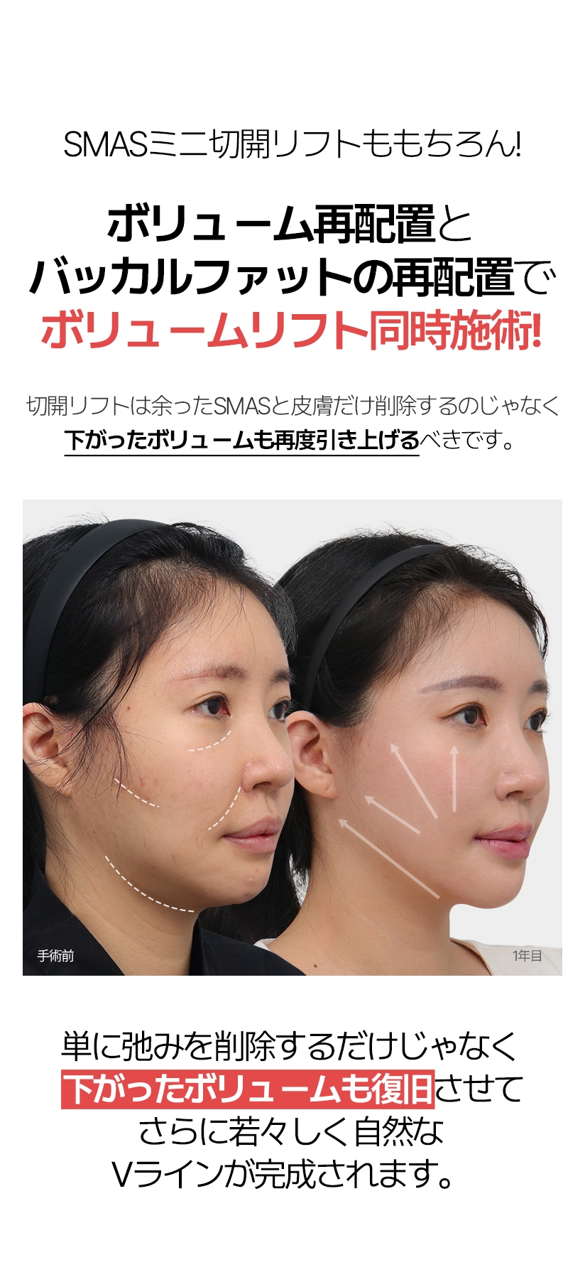 SMASミニ切開リフトももちろん! ボリューム再配置 とバッカルファットの再配置で  ボリュームリフト同時施術！ 切開リフトは余ったSMASと皮膚だけ削除するのじゃなく 下がったボリュームも再度引き上げるべきです。単に弛みを削除するだけじゃなく 下がったボリュームも復旧させて さらに若々しく自然なVラインが完成されます。