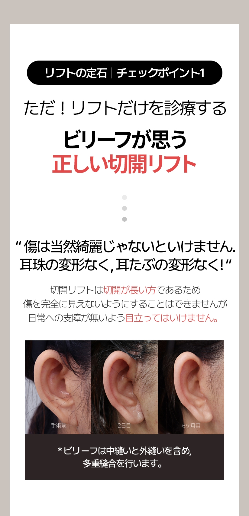 リフトの定石  |  チェックポイント 1 ただ！リフトだけを診療する ビリーフが思う正しい切開リフト “傷は当然綺麗じゃないといけません。耳珠の変形なく, 耳たぶの変形なく!” 切開リフトは切開が長い方であるため傷を完全に見えないようにすることはできませんが 日常への支障が無いよう目立ってはいけません。手術前   2日目   6ヶ月目 * ビリーフは中縫いと外縫いを含め, 多重縫合を行います。