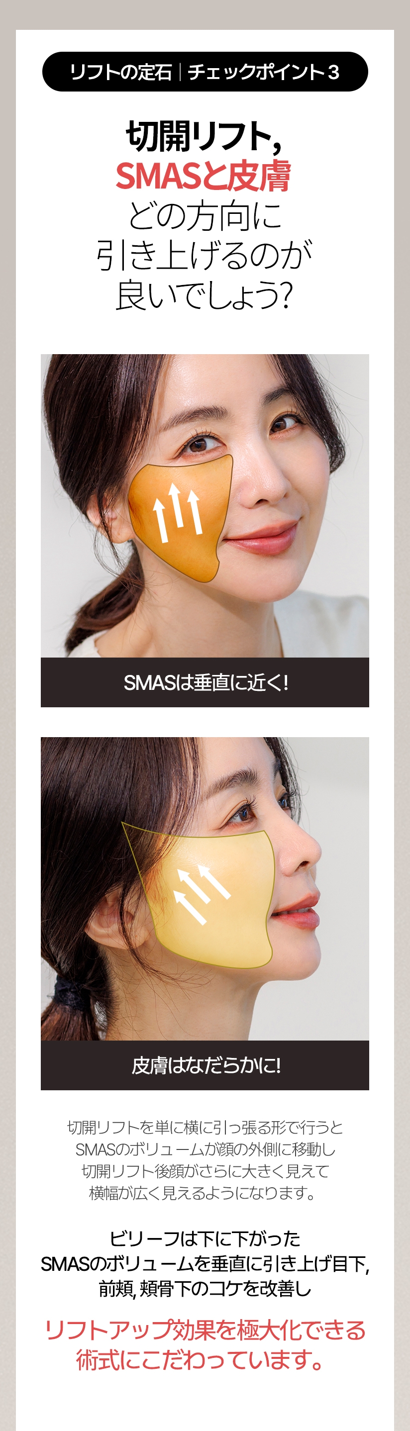リフトの定石  |  チェックポイント3 切開リフト, SMASと皮膚 どの方向に 引き上げるのが良いでしょう? SMASは垂直に近く! 皮膚はなだらかに! 切開リフトを単に横に引っ張る形で行うとSMASのボリュームが顔の外側に移動し 切開リフト後顔がさらに大きく見えて横幅が広く見えるようになります。ビリーフは下に下がったSMASのボリュームを垂直に引き上げ目下、前頬、頬骨下のコケを改善し リフトアップ効果を極大化できる術式にこだわっています。
