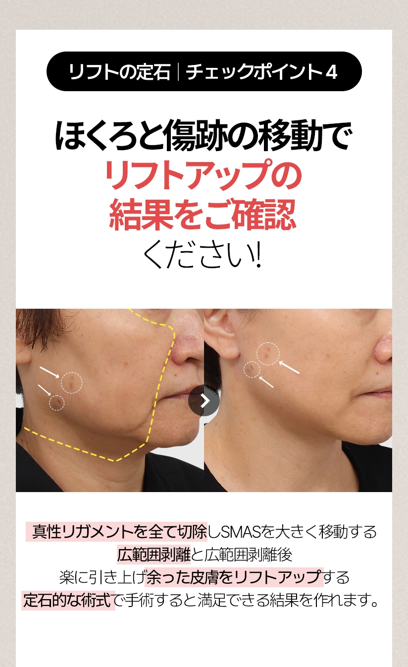 リフトの定石  |  チェックポイント4 ほくろと傷跡の移動で リフトアップの結果をご確認ください! 真性リガメントを全て切除しSMASを大きく移動する広範囲剥離と広範囲剥離後 楽に引き上げ余った皮膚をリフトアップする定石的な術式で手術すると満足できる結果を作れます。