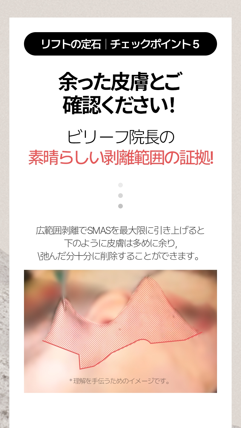 リフトの定石  |  チェックポイント5 余った皮膚とご確認ください! ビリーフ院長の 素晴らしい剥離範囲の証拠! 広範囲剥離でSMASを最大限に引き上げると 下のように皮膚は多めに余り、弛んだ分十分に削除することができます。* 理解を手伝うためのイメージです。