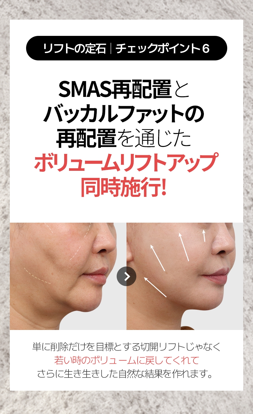 リフトの定石  |  チェックポイント6 SMAS再配置とバッカルファットの再配置 を通じたボリュームリフトアップ同時施行! 単に削除だけを目標とする切開リフトじゃなく 若い時のボリュームに戻してくれて さらに生き生きした自然な結果を作れます。